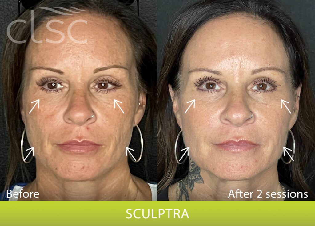 Sculptra Before & After Columbia Laser Skin Center