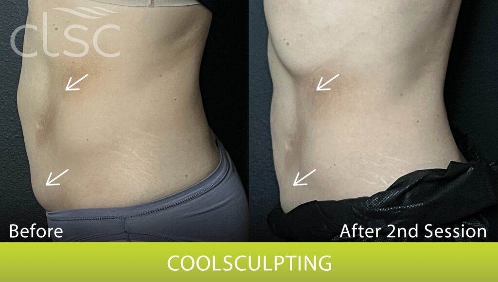 CoolSculpting_Trunk_Female18_LeftLateral_HR_Print