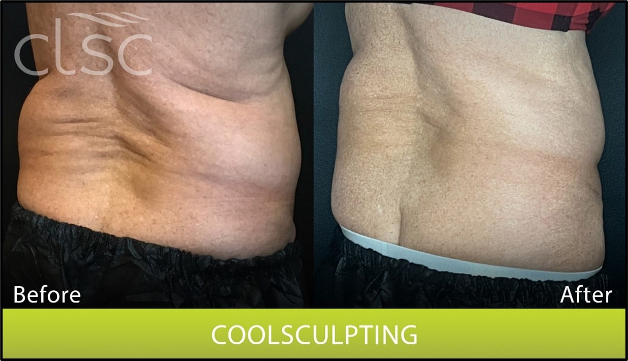 CoolSculpting vs. Liposuction Sculpt Your Ideal Body Safely and