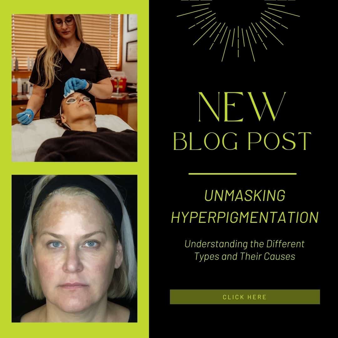 Unmasking Hyperpigmentation Understanding the Different Types and Their Causes