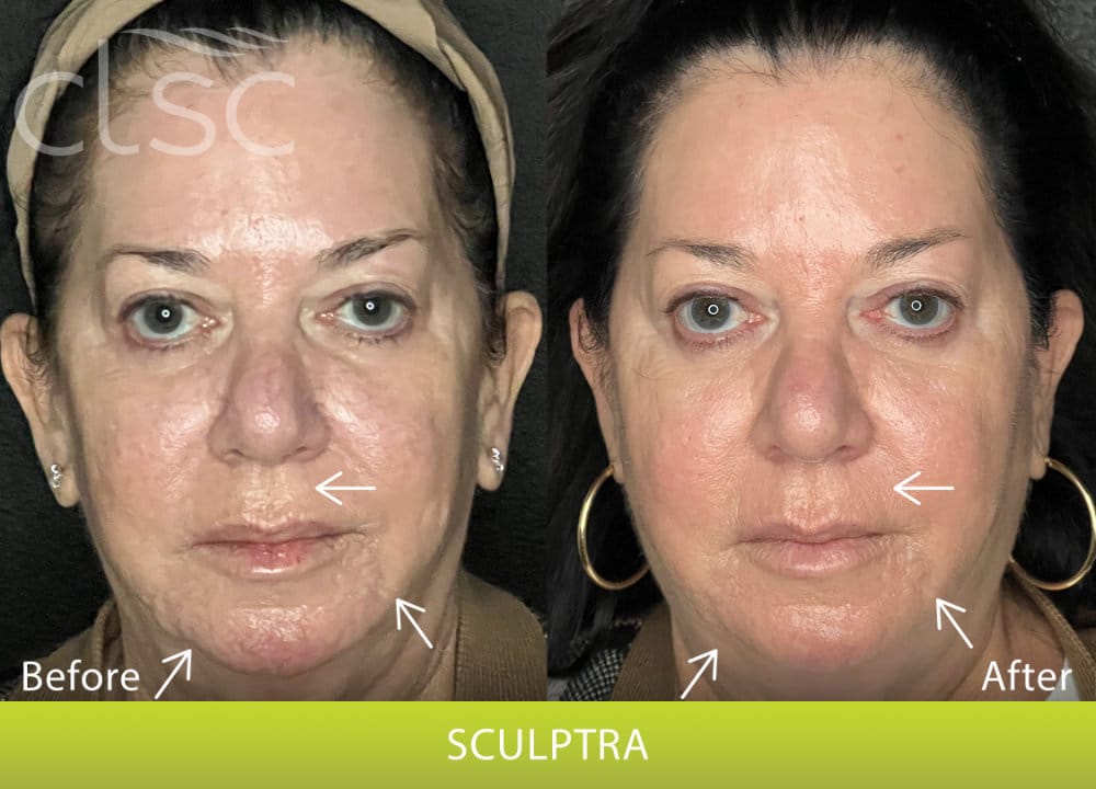 BeforeAndAfterPhoto_Sculptra_HightRes_Female12_Frontal