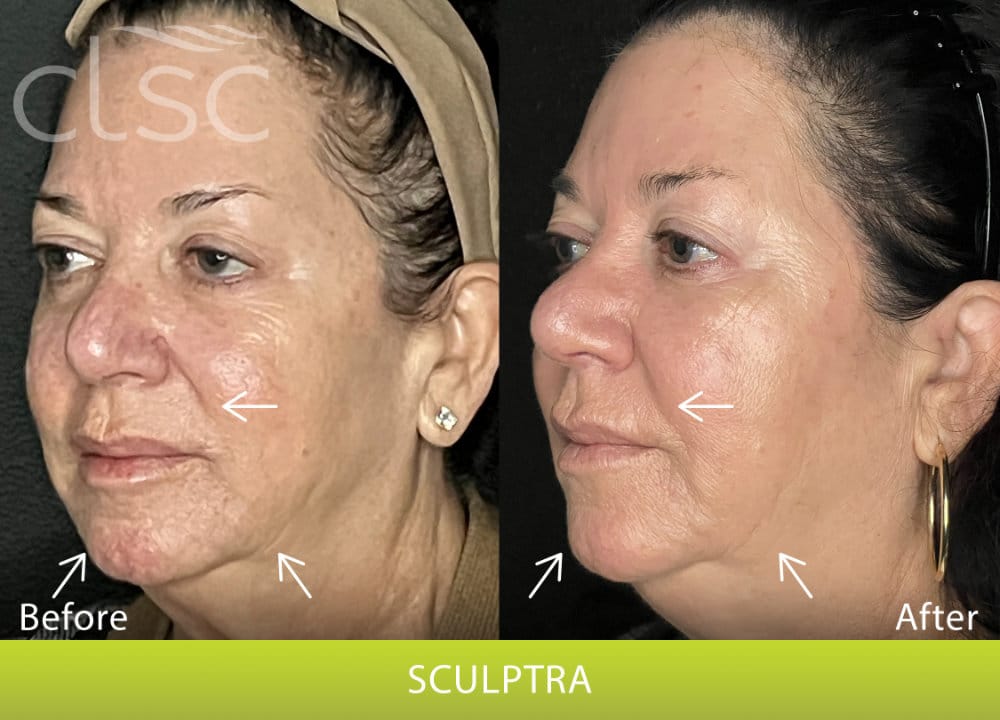BeforeAndAfterPhoto_Sculptra_HightRes_Female12_Left_Oblique