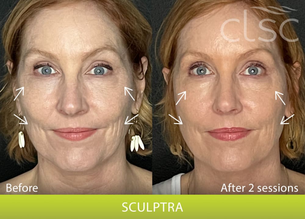 BeforeAndAfterPhoto_Sculptra_HightRes_Female3_Frontal_withArrows_Update