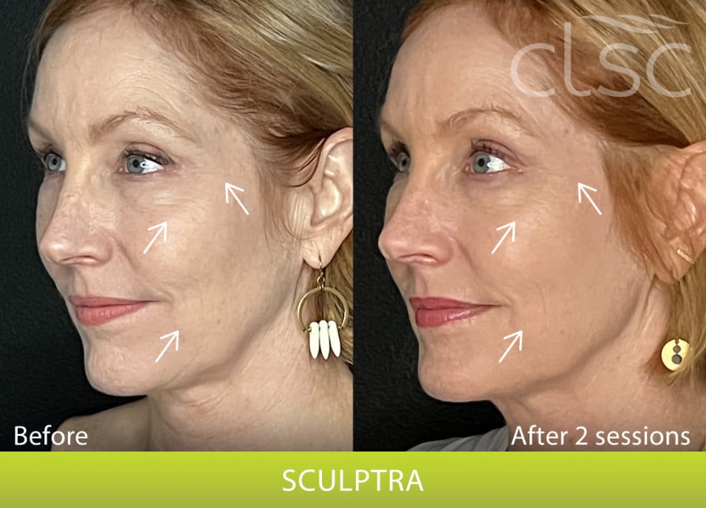 BeforeAndAfterPhoto_Sculptra_HightRes_Female3_Left_Oblique_withArrows_Update