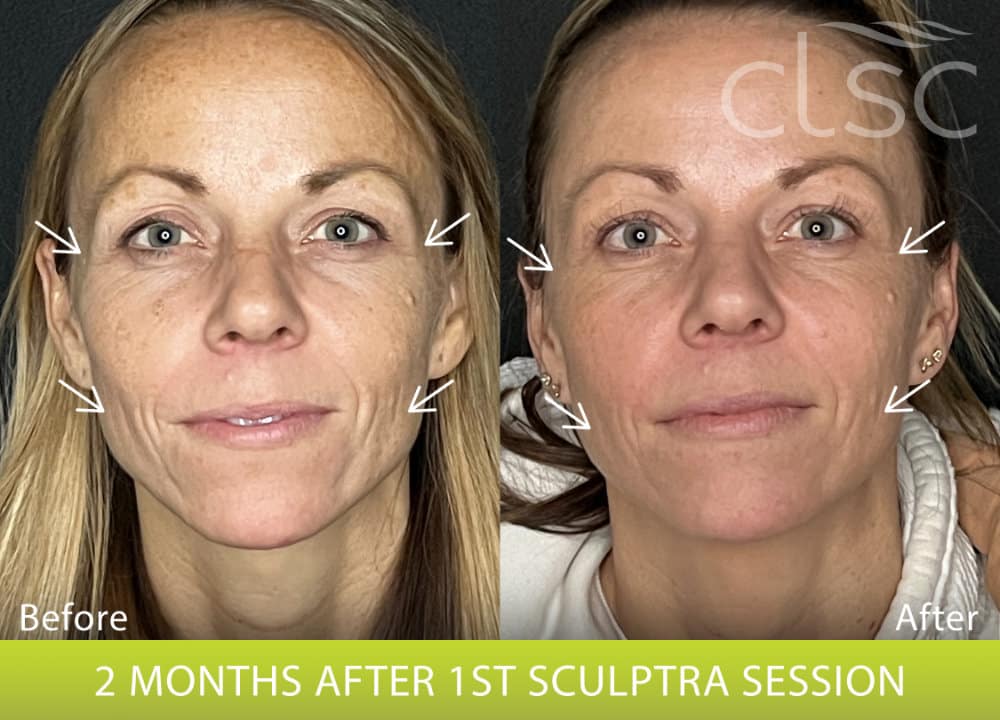 BeforeAndAfterPhoto_Sculptra_HightRes_Female4_Frontal_withArrows