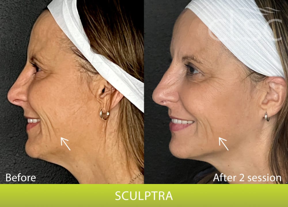 BeforeAndAfterPhoto_Sculptra_HightRes_Female8_Left_Lateral