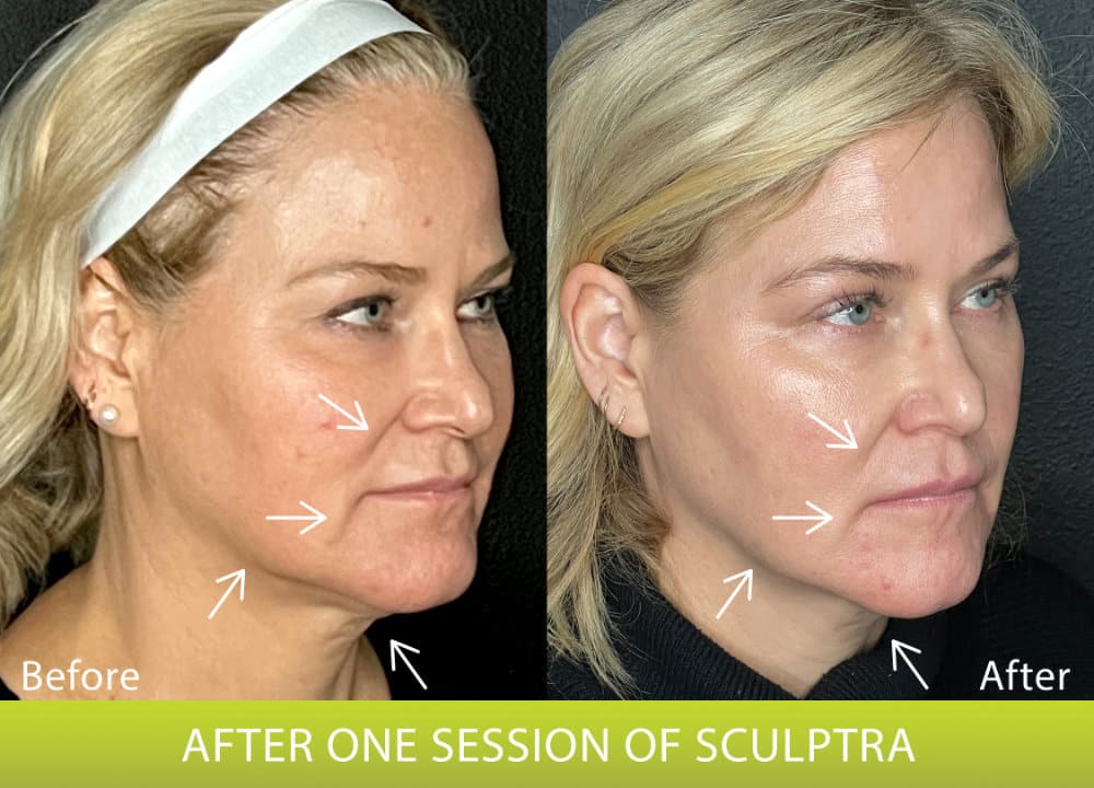 BeforeAndAfterPhoto_Sculptra_HightRes_Shawna_RightOblique