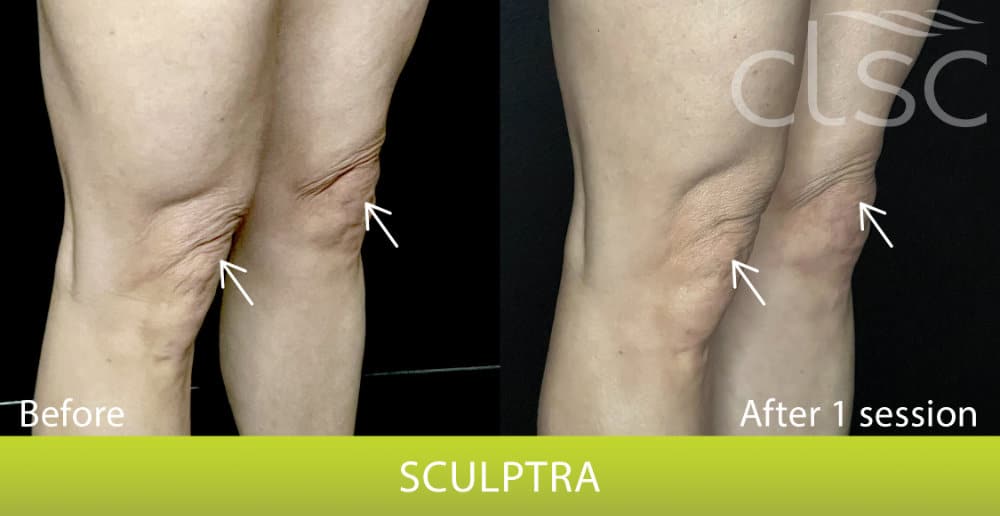 BeforeAndAfterPhoto_Sculptra_Knees_RightOblique