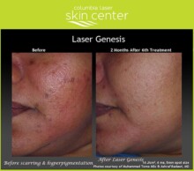 Laser Genesis facial skin treatment - available for Hood River, The Dalles and surrounding areas in Oregon and Washington at Columbia Laser Skin Center