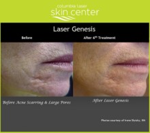 Laser Genesis scar treatment - available for Hood River, The Dalles and surrounding areas in Oregon and Washington at Columbia Laser Skin Center
