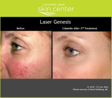 Laser Genesis facial skin treatment - available for Hood River, The Dalles and surrounding areas in Oregon and Washington at Columbia Laser Skin Center