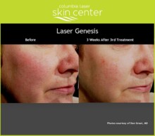 Laser Genesis facial skin treatment - available for Hood River, The Dalles and surrounding areas in Oregon and Washington at Columbia Laser Skin Center