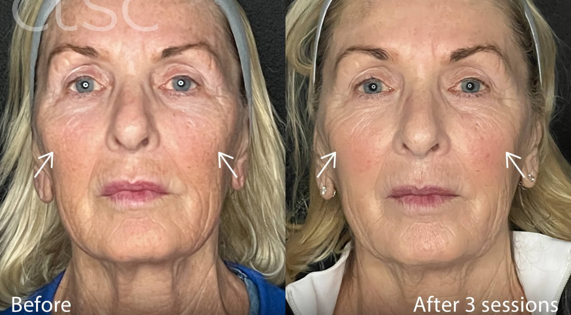 BeforeAndAfterPhoto_Sculptra_HightRes_Female5_Frontal_withArrows