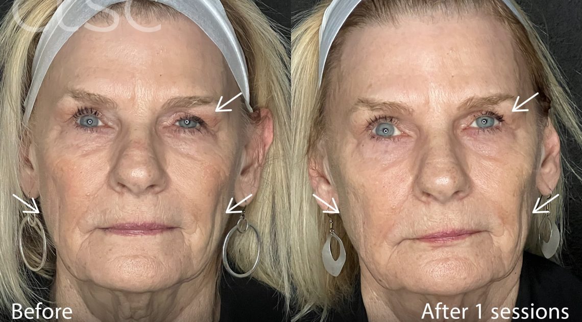 BeforeAndAfterPhoto_Sculptra_HightRes_Female6_Frontal_withArrows