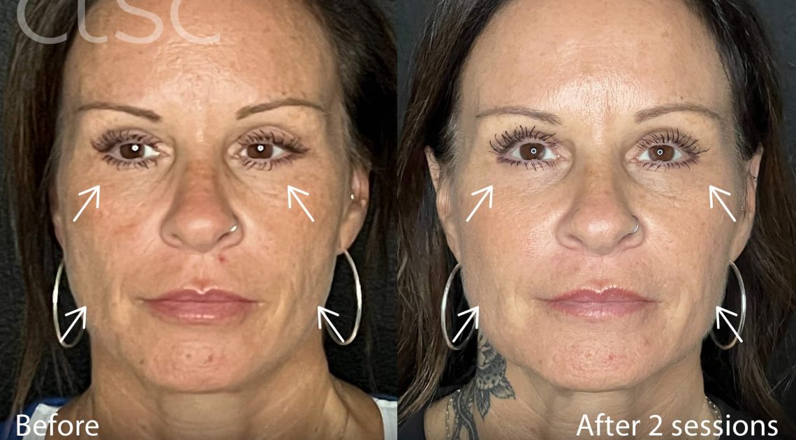 BeforeAndAfterPhoto_Sculptra_HightRes_Female7_Frontal_withArrows