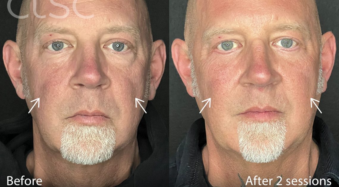 BeforeAndAfterPhoto_Sculptra_HightRes_Male2_Frontal_withArrows